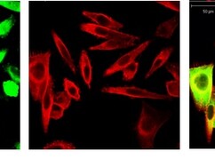 Metastatische Melanomzellen unterm Mikroskop betrachtet
